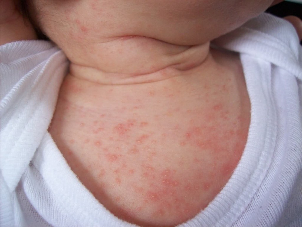 Figure 1. Erythema Toxicum Neonatorum